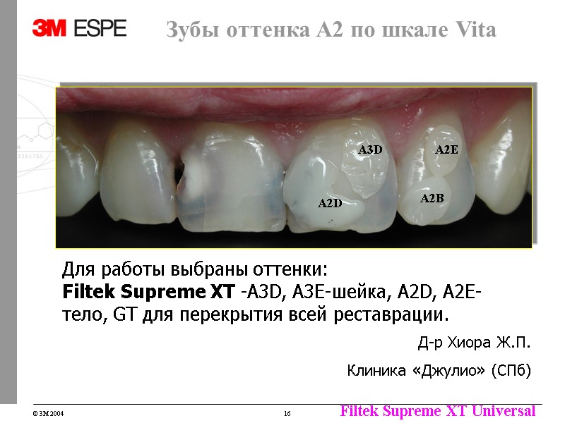 Зубы оттенка А2 по шкале Vita Д-р Хиора Ж.П. Клиника «Джулио» (СПб) A2D A3D Зубы оттенка А2 по шкале Vita Д-р Хиора Ж.П. Клиника «Джулио» (СПб) A2D A3D